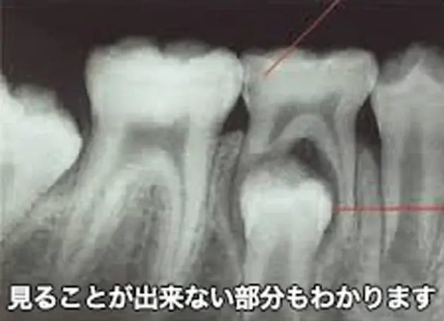 むし歯や歯茎の状態(写真)