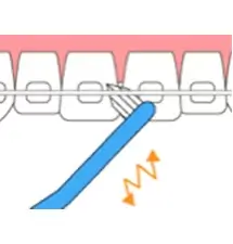 ブラッシング3(歯ブラシを使い分け)図